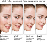 Aichun Beauty Anti - Acne Whitening Facial Serum Aloe Vera Extract Salicylic Acid Repairs Damaged Skin | 30ml