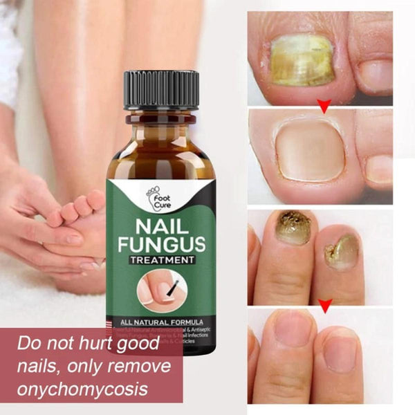 Original Nail Fungus Treatment Stop Fungal Growth Effective Fingernail 10ml