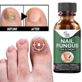 Fast Nail Fungal Treatments Nail Repair Essences Serum Care Treatments Foot Nail Fungus Removal Gel Paronychia Onychomycosis