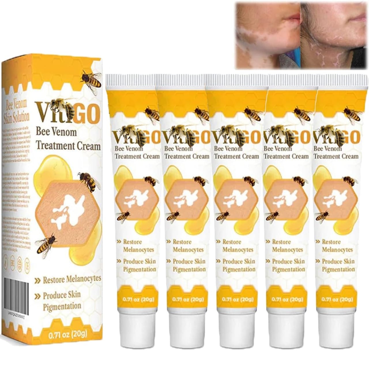 Bee Venom Vitiligo Treatment Cream - Restore Melanocytes & Skin Pigmentation - Natural Melanin Care Ointment for Leukoplakia (20g)