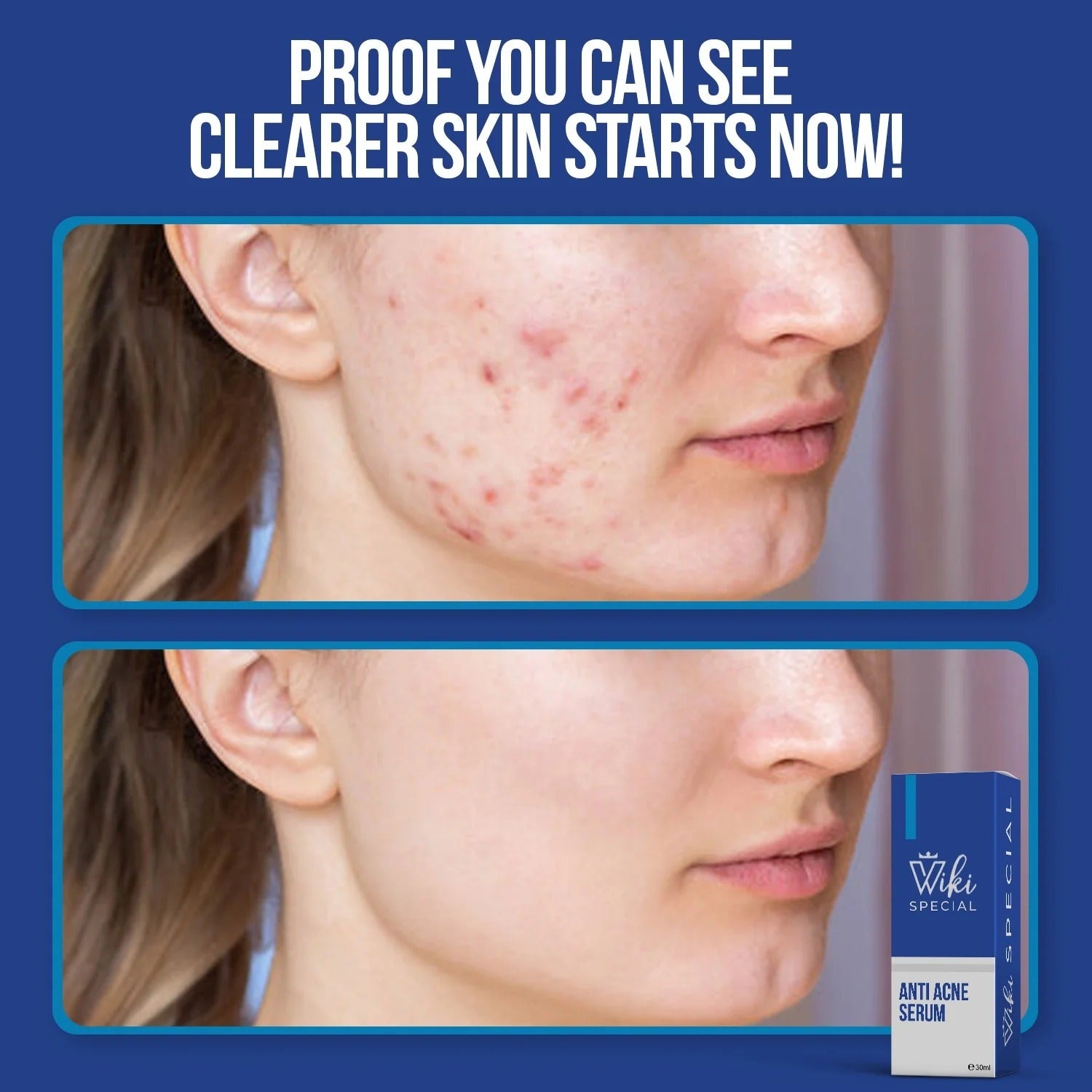 Wiki Special Anti Acne Serum | Clears Acne, Soothes Skin & Fights Blemishes (30ml)