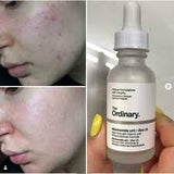 The Ordinary Niacinamide 10% + Zinc 1 % - 30ml |Oil Control, Pore Minimizing &amp; Blemish Solution Serum