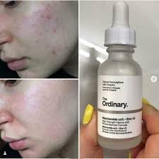 The Ordinary Niacinamide 10% + Zinc 1 % - 20 ml  |Oil Control, Pore Minimizing &amp; Blemish Solution Serum