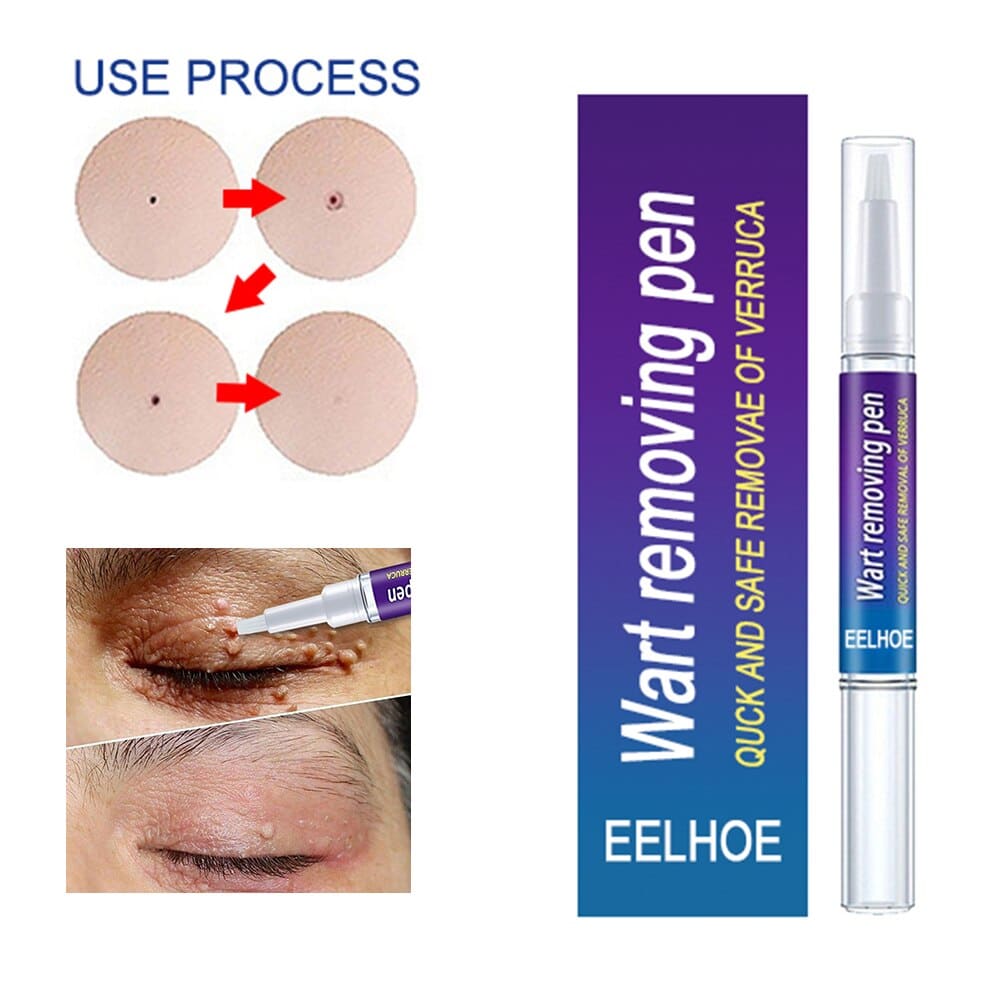Warts Remover Original Cream Wart Removal Ointment Wart Treatment Skin Tag Mole Remover Antibacterial Foot Wart