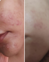 Nirvana Botanics Vitamin C + E Serum - 15ml | ANTI ACNE &amp; GLOWING SERUM VITAMIN C + E