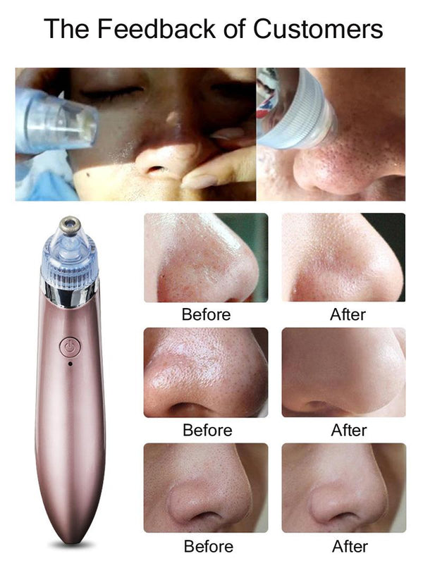 JB- 8620 Beauty Skin Care Expert Acne Pore Cleaner Acne  Beauty skin care specialist 5in1